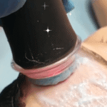 Realizacja zabiegu Geneo by Pollogen