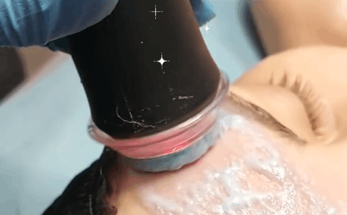 Realizacja zabiegu Geneo by Pollogen