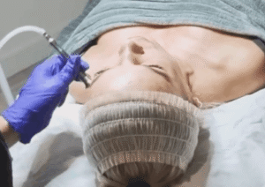 Wykonanie zabiegu dermaoxy